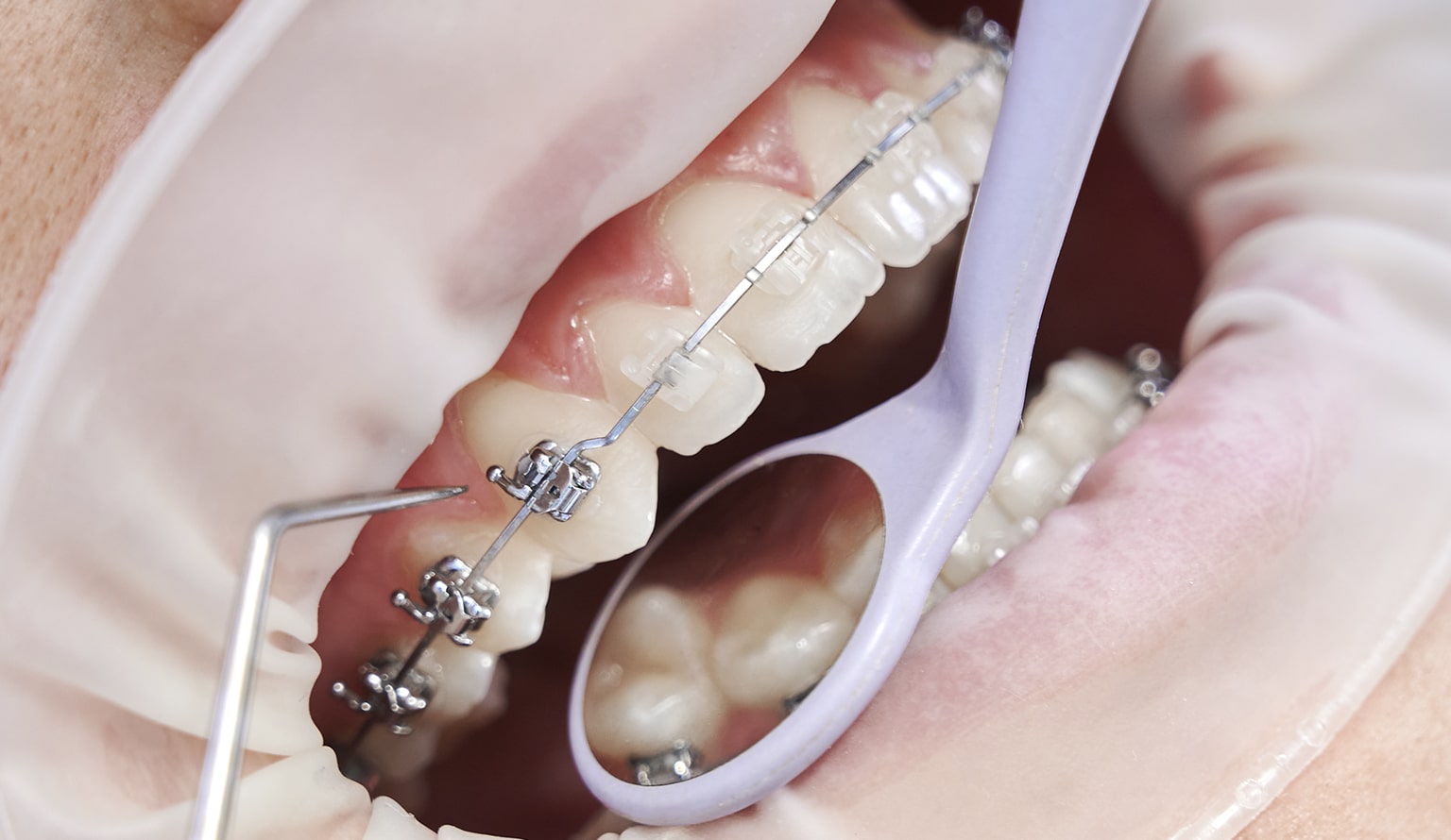 PreDental Implant Orthodontics A Key to Prevent Neighbour Teeth