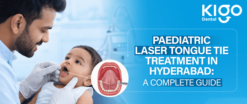 Laser Tongue Tie Treatment in Hyderabad