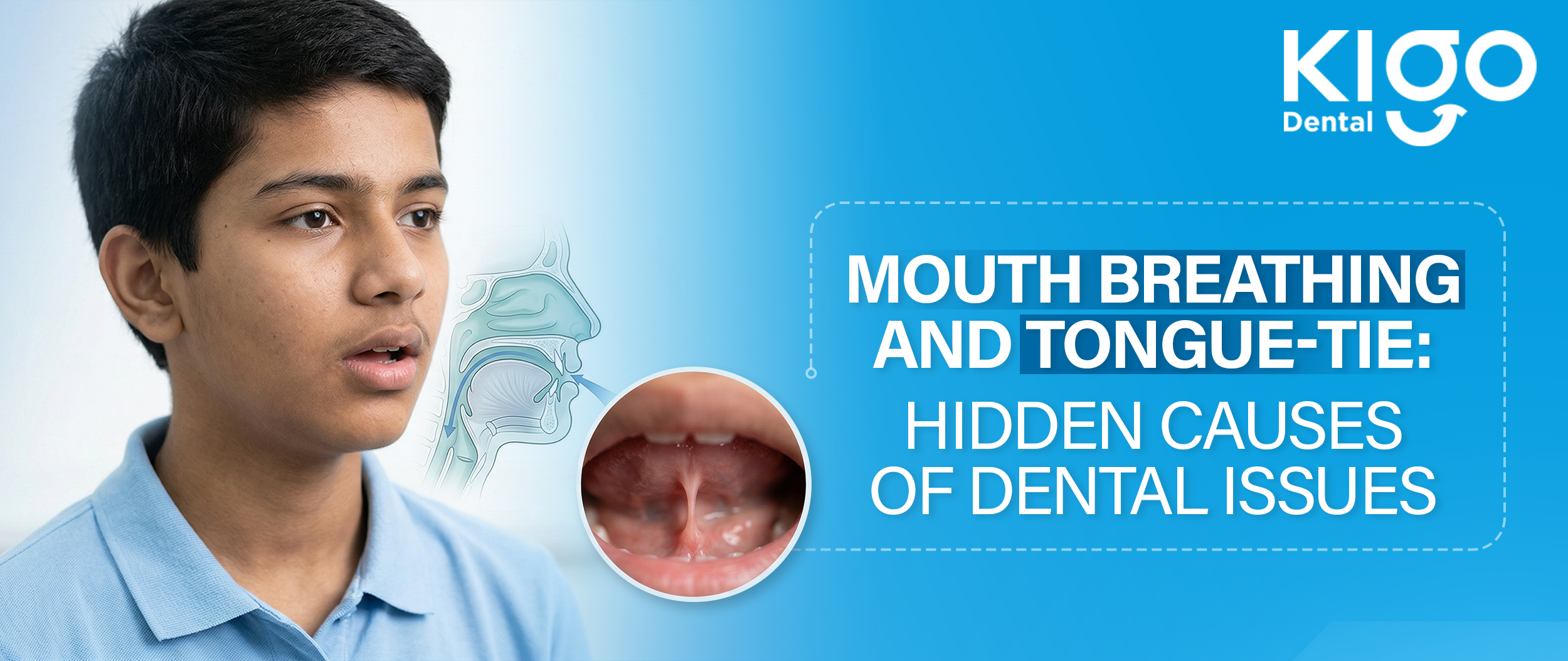 Mouth Breathing Treatment In Hyderabad